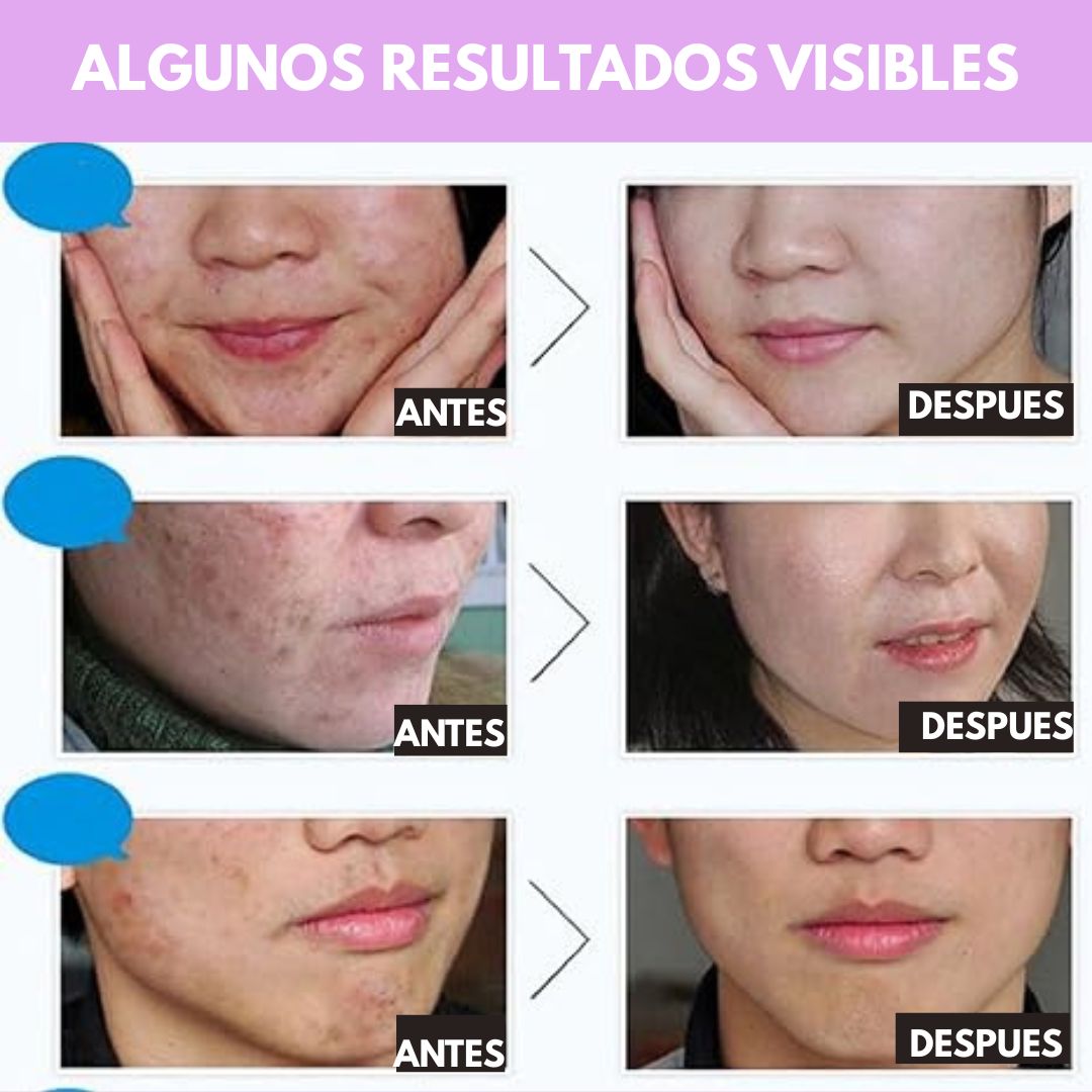 Kit Anti Acné De Bioaqua 3 en 1